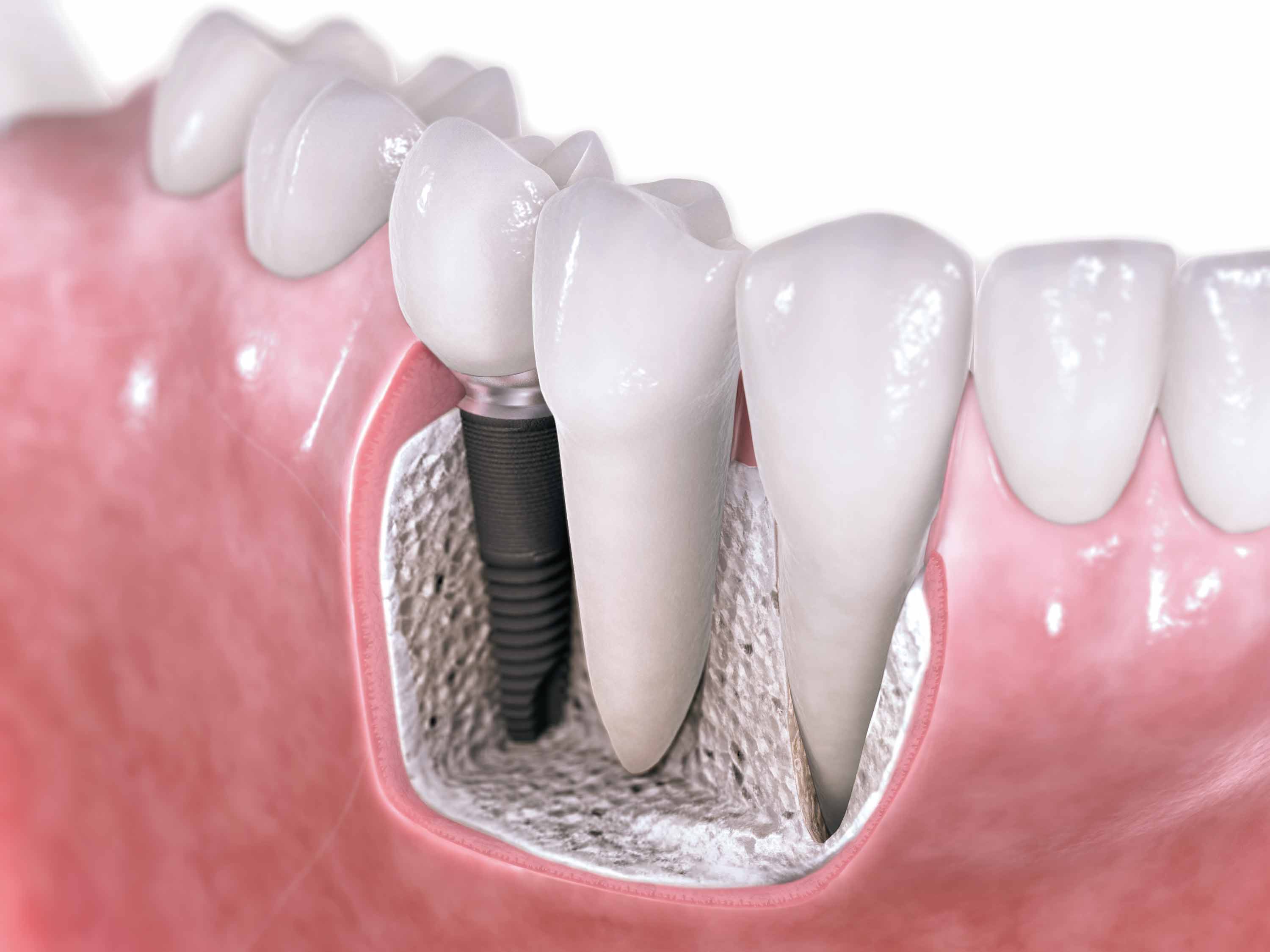 Dental Implants In Summerlin