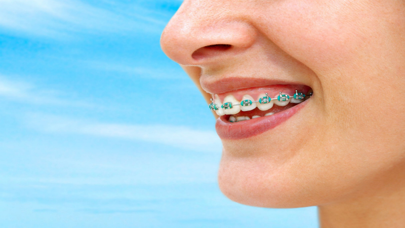 How Braces Can Change Your Life