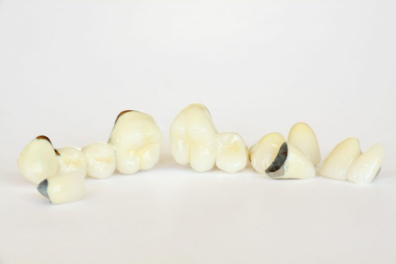 Frequently Asked Questions About Dental Bridges