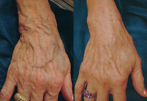 How to get effective varicose veins treatment