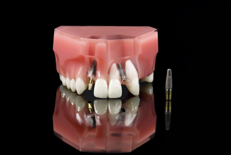 Do You Need a Tooth Implant in Panama City Beach, FL?