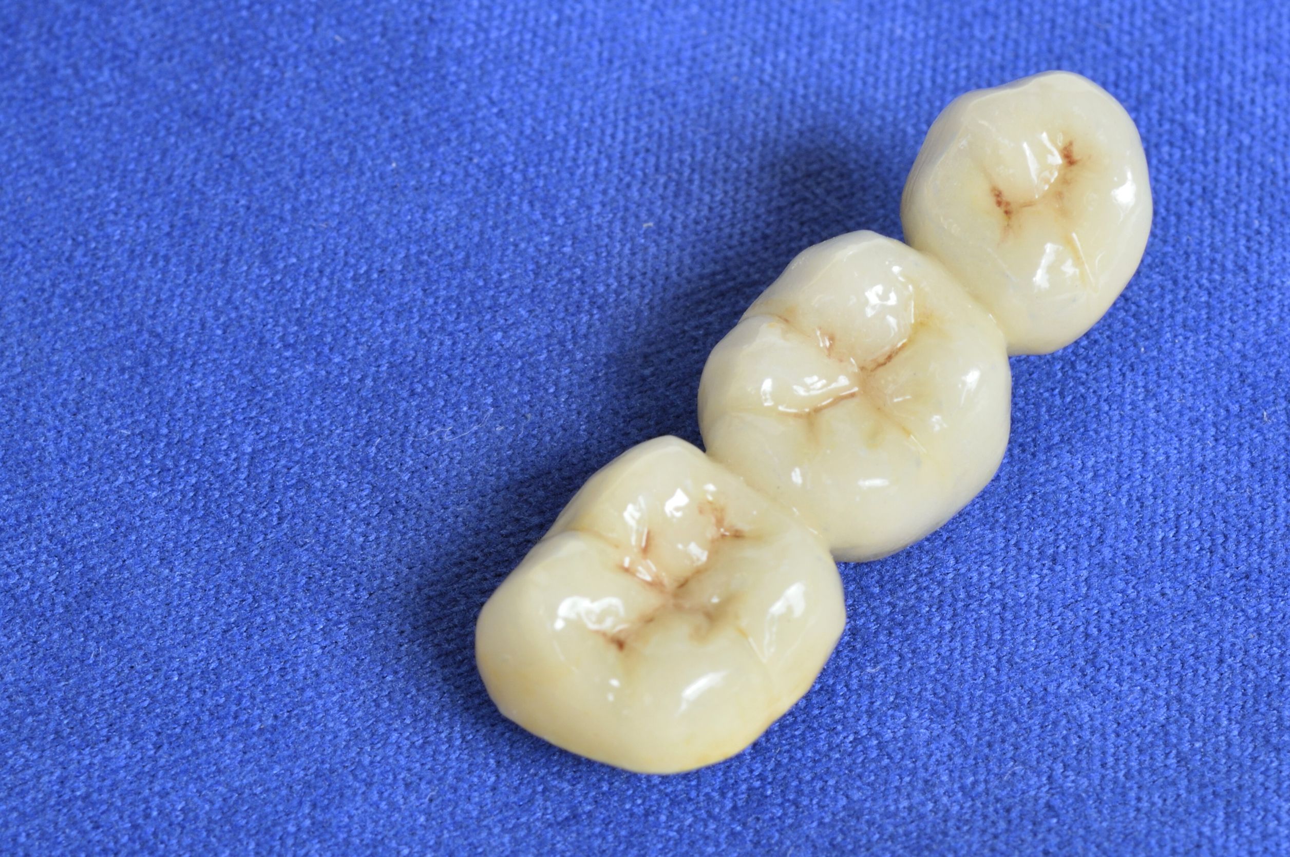 Do You Need a New Tooth Crown in Arlington?