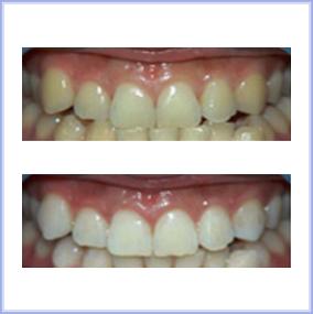 Dental Teeth Bleaching Can Make Your Smile Brighter