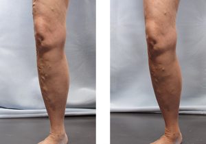 Should You Treat Your Varicose Veins?
