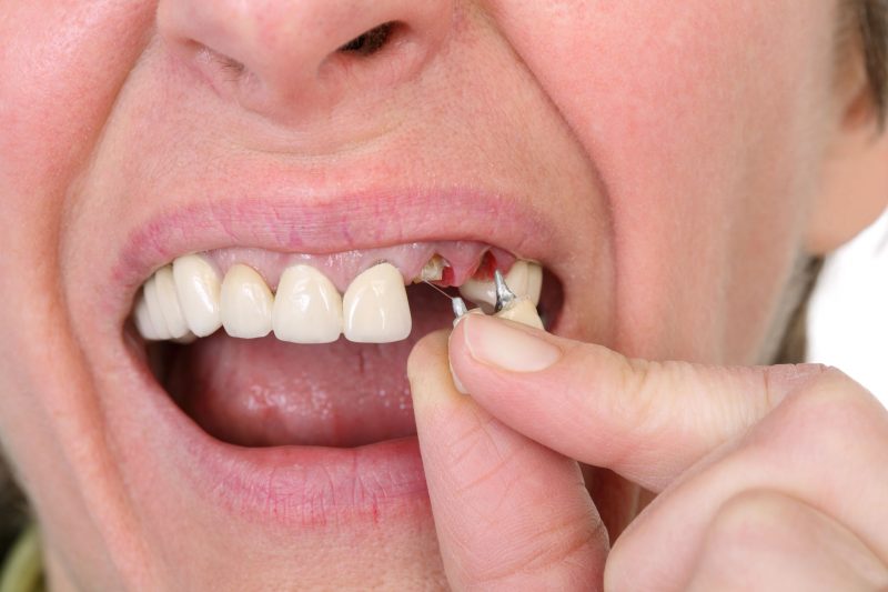 What Can Individuals Expect From Tooth Extractions in Billings MT?