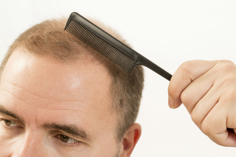 Thinning Hair in Philadelphia? Improve your Receding Hairline with FUE