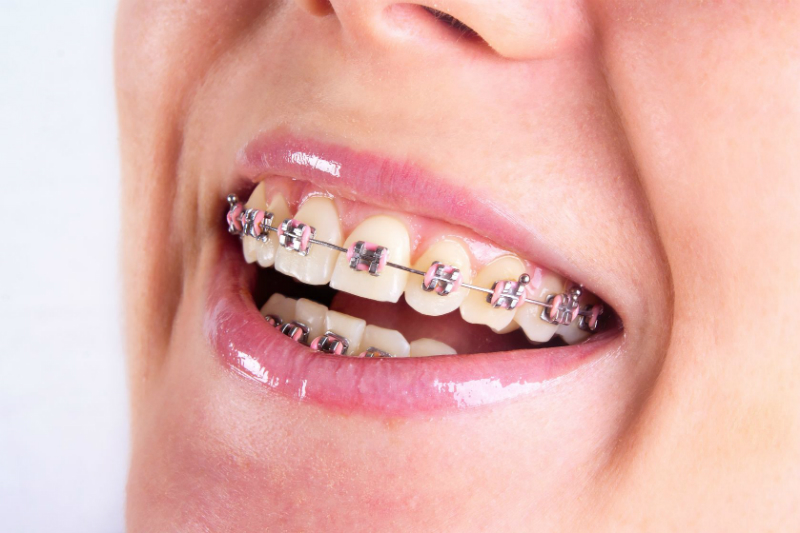 The Top Benefits You Can Reap From Getting Braces As An Adult