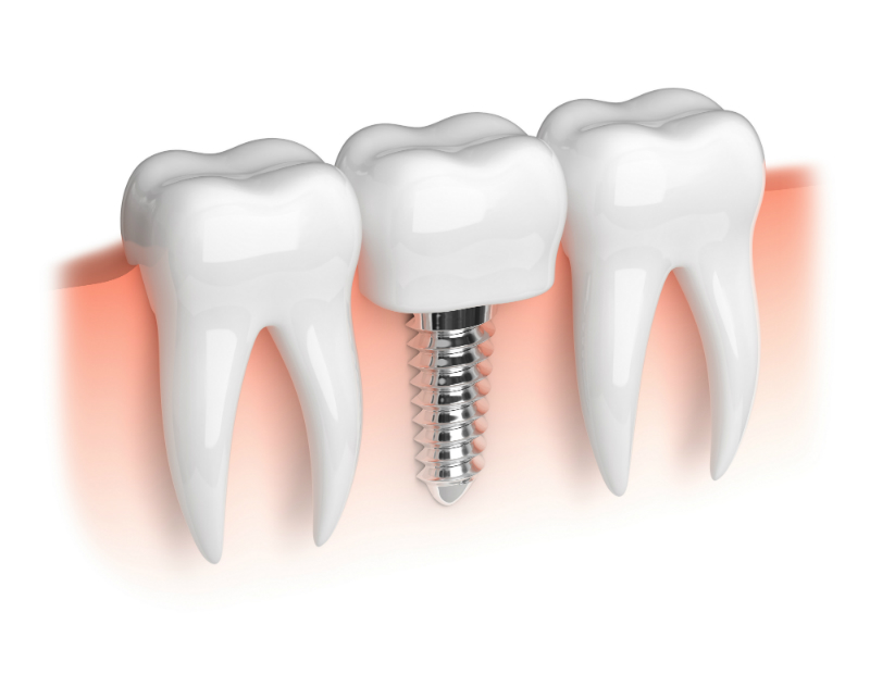 Knowledge about Dental Implants in Charleston SC