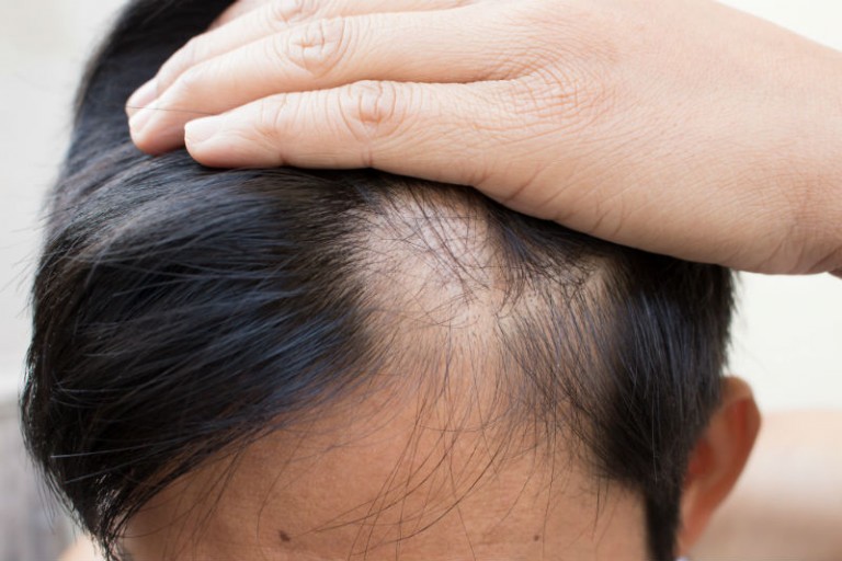 Why Philadelphia Residents Prefer the FUE Hair Transplant Method