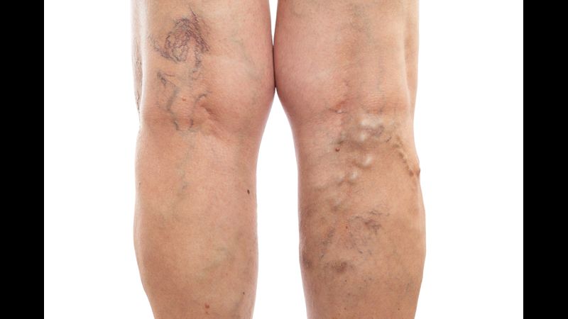 What to Look for in a Vein Doctor in Bensalem, PA