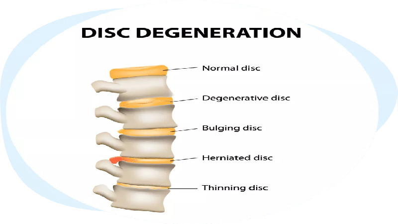 Things to Know When Looking for Bulging Disk Treatment in Glendale, AZ