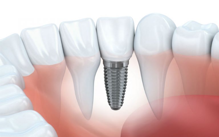 Dental Implants In Fairfield County CT Through Your Local Dentist