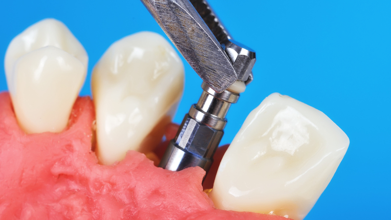 GETTING DENTAL BRIDGES IN Melbourne FL CAN ALLOW YOU TO REPLACE THE TEETH YOU’VE LOST