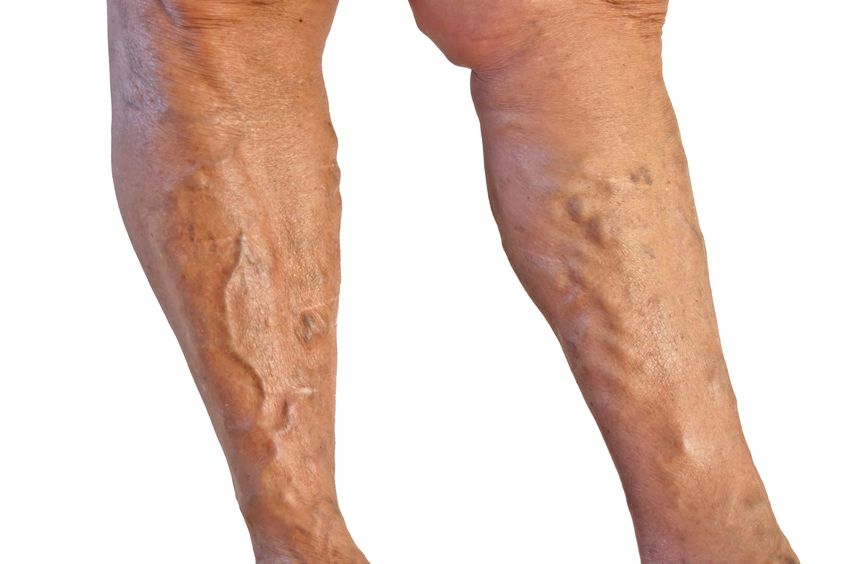 Could You Benefit from Sclerotherapy in Schaumburg