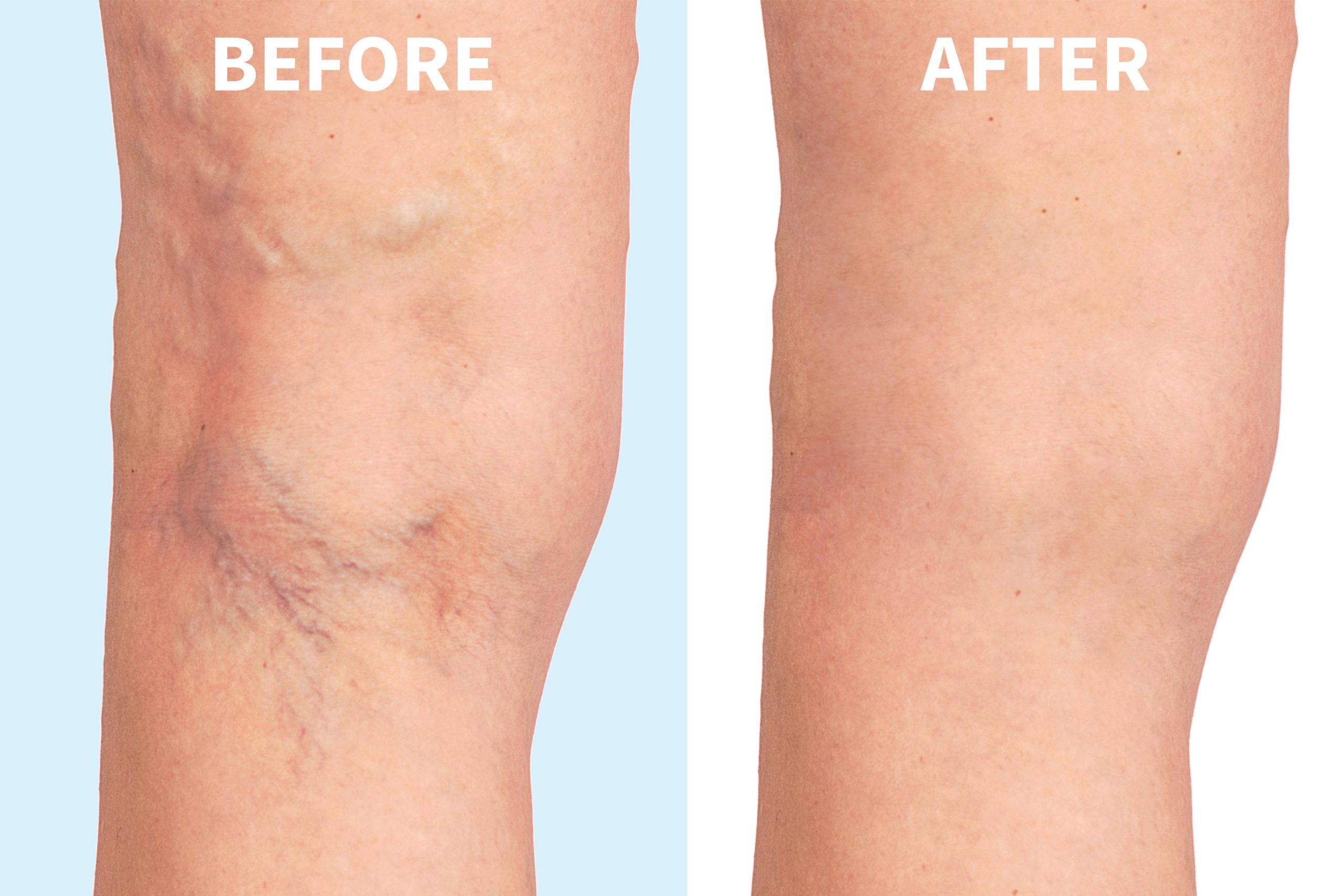 Relief for Leg Pain and Swelling with a Vein Specialist in Warrenton, VA