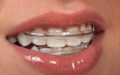 Benefits Of Choosing Braces In Medina OH For Confident Healthy Smiles