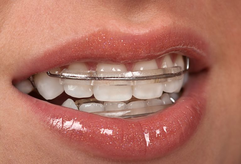 Benefits Of Choosing Braces In Medina OH For Confident Healthy Smiles