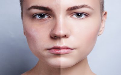 Reveal Youthful Results With Skin Rejuvenation Louisville KY Solutions for All Skin Types