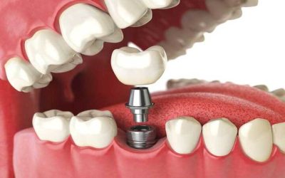 Improving Confidence with Dental Crowns Dayton Patients Trust for Natural Results