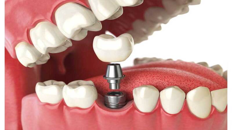 Achieve Your Best Smile with Personalized Care at a Dental Clinic Carina QLD