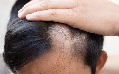Finding the Right Hair Restoration Specialist in Amherst, NY